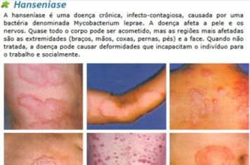 Janeiro Roxo - Mês de Prevenção a Hanseníase